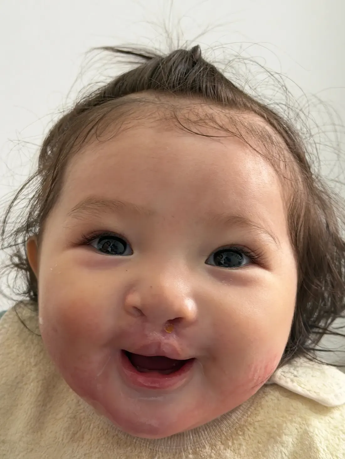 Bebé sonriendo después de su cirugía de labio y paladar hendido